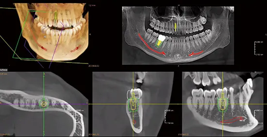 Fussen Rubik X1: Centrum implantów