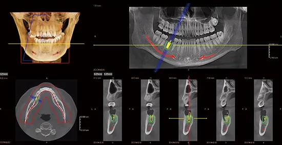 Fussen Rubik X1: Symulacja implantacji