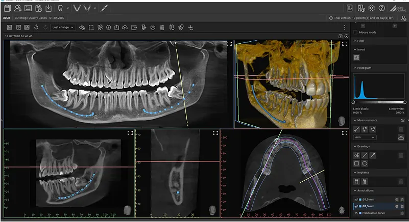 Tomograf VistaVox S 3D: Automatyczna analiza AI