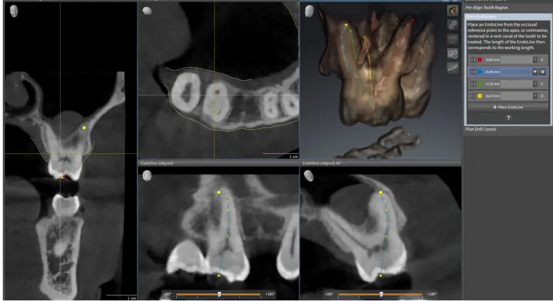 Tomograf VistaVox S 3D: Planowanie zabiegów endodontycznych