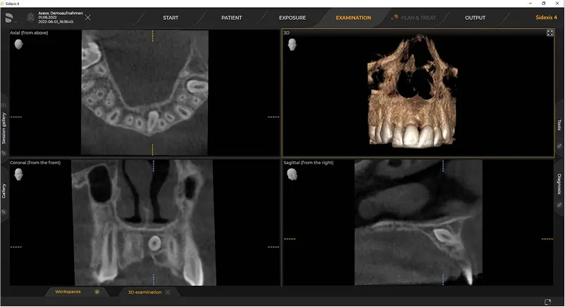 Dentsply Sirona Axeos: Minimalizacja dawki promieniowania