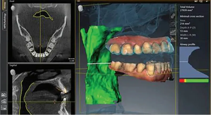 Dentsply Sirona Axeos: Wizualizacja dróg oddechowych