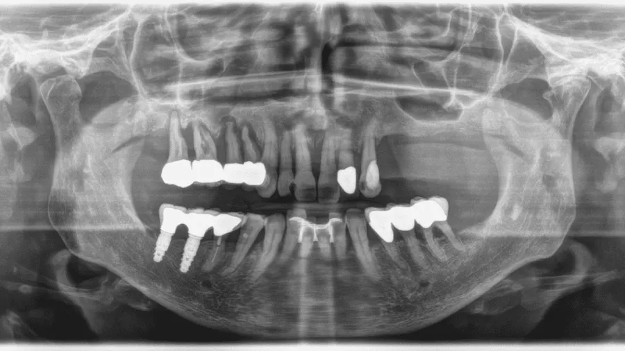 Dentsply Sirona Orthophos E: Przykład 3