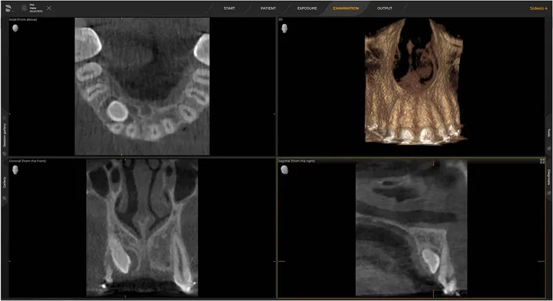 Dentsply Sirona Orthophos S 3D: Optymalizacja ekspozycji