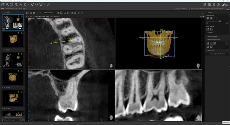 Tomograf VistaVox S 3D: Precyzyjna diagnostyka endodontyczna