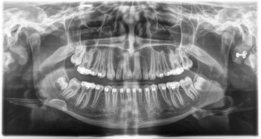 Dentsply Sirona Orthophos E: Przykład 1