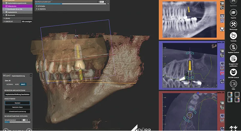 Tomograf VistaVox S 3D: Planowanie implantów