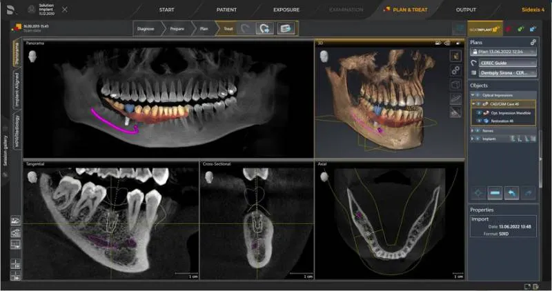 System Dentsply Sirona InLAB: Dane są łączone z danymi rentgenowskimi 3D