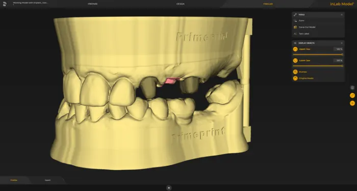 System Dentsply Sirona InLAB: Modele mogą być zaprojektowane z wyjmowanymi lub stałymi słupkami