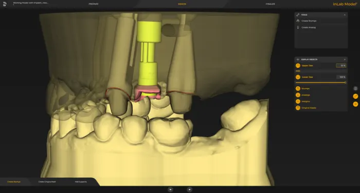 System Dentsply Sirona InLAB: Rozmiar słupków i regulacja podcieni dla wyjmowanych lub stałych słupków może być dopasowywana indywidualnie
